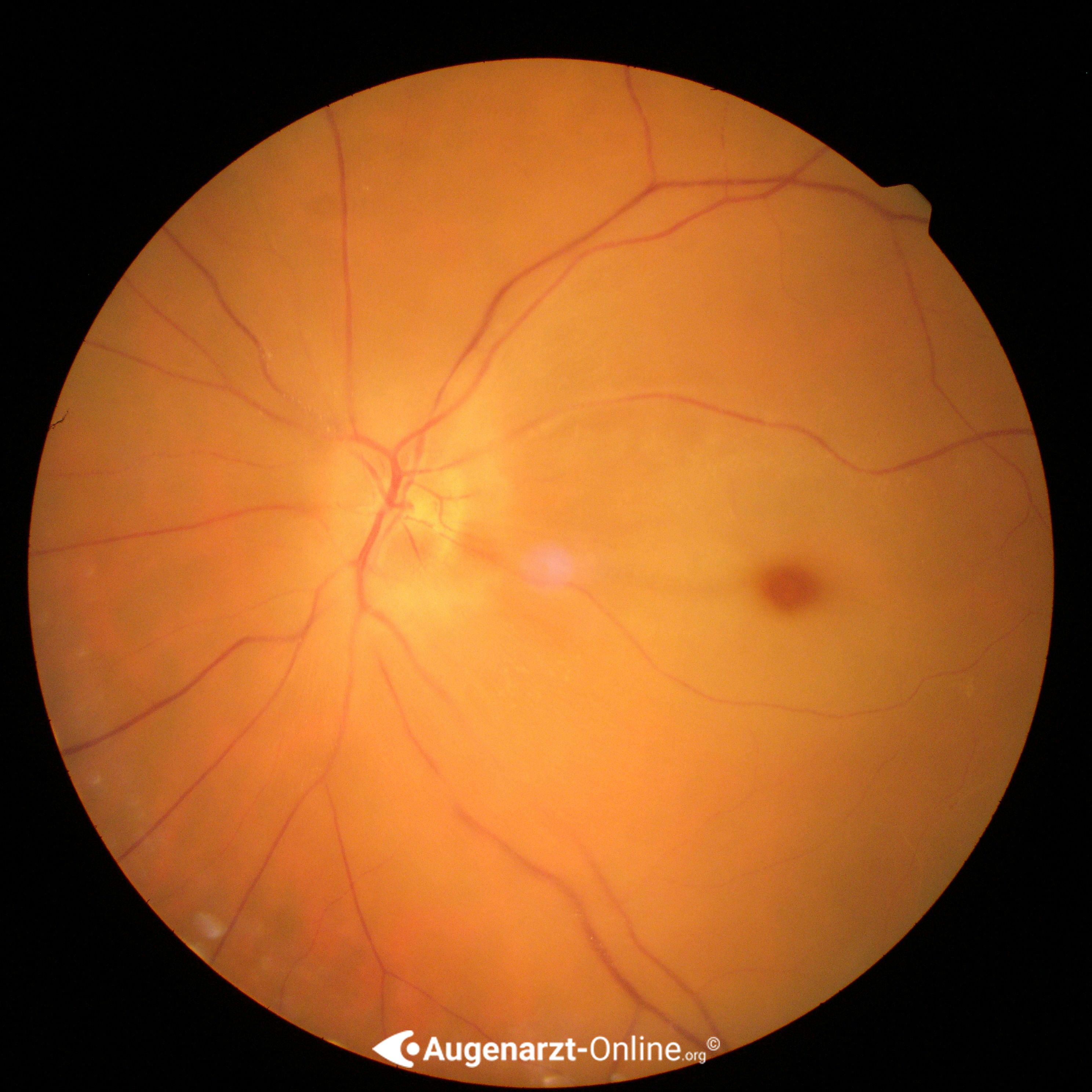 Amaurosis fugax | Lexikon der Augenheilkunde